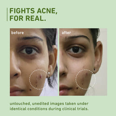 Close-up faces with acne spots, before-and-after comparison and circular markers