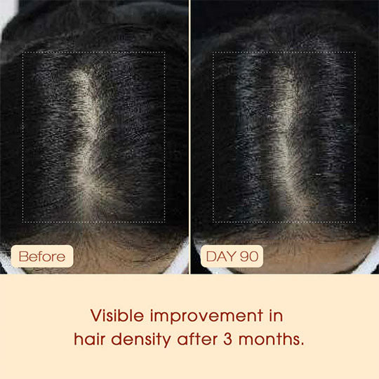 Hair and scalp comparison: before vs day 90, showing hair density