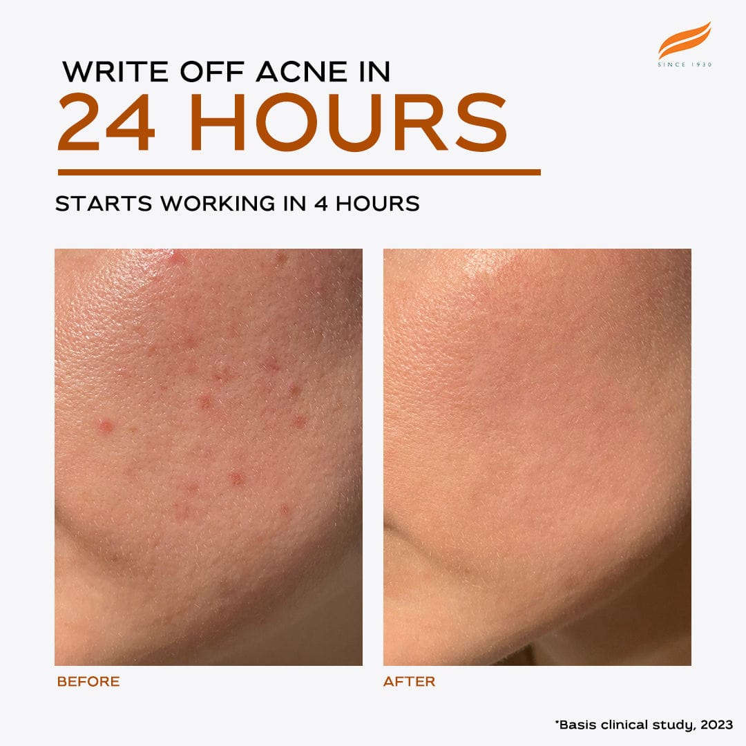 Himalaya - Acne Clear+ Spot Treatment Pen with 2% Natural Salicylic Acid Reducing Acne Size in 24 hrs 15ml